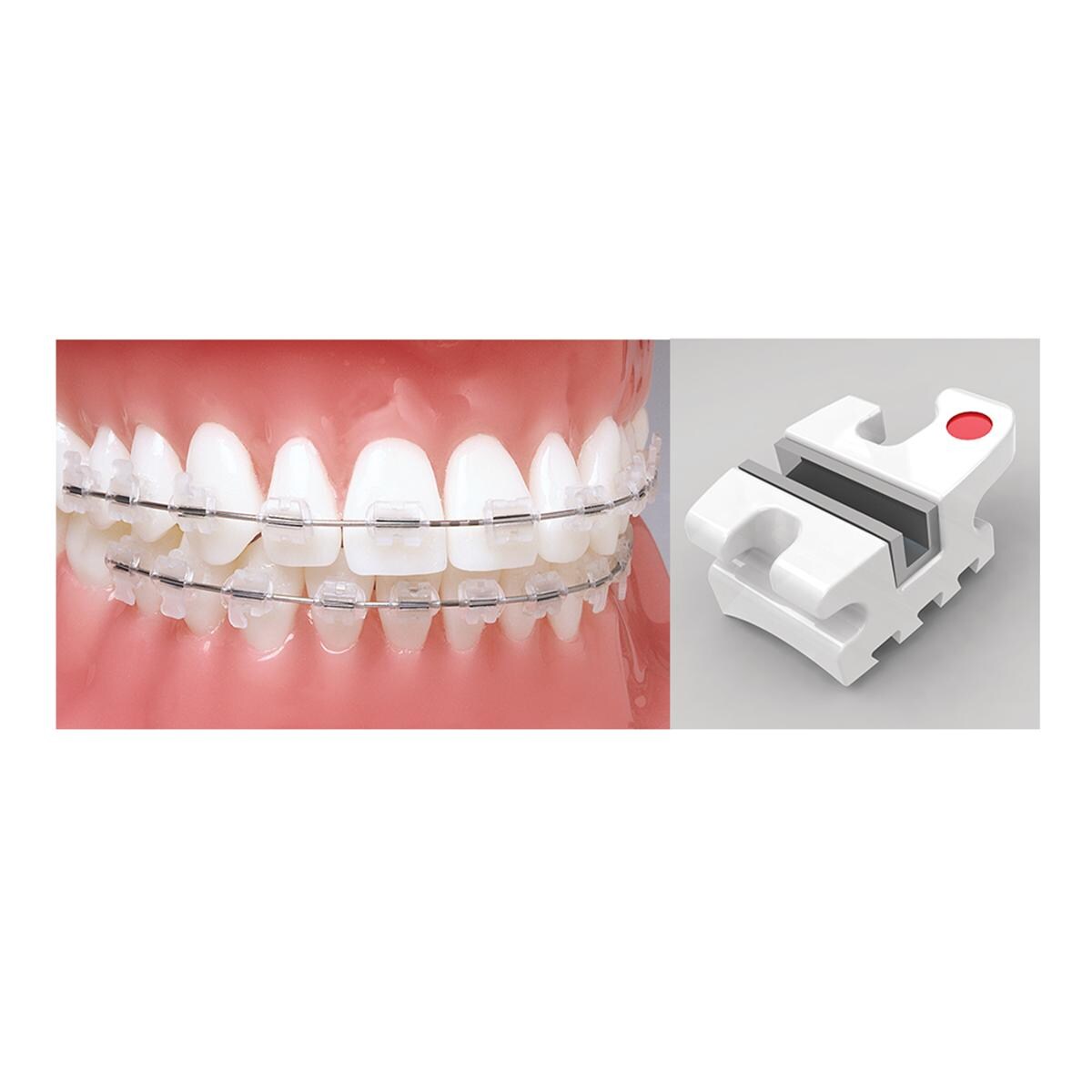 Avalon Roth Prescription .018" Slot, mit Torque - 6° auf 1 ern und 2 ern und - 11° auf 3ern, Einzelpackung - Zahn 31, 32, 41, 42