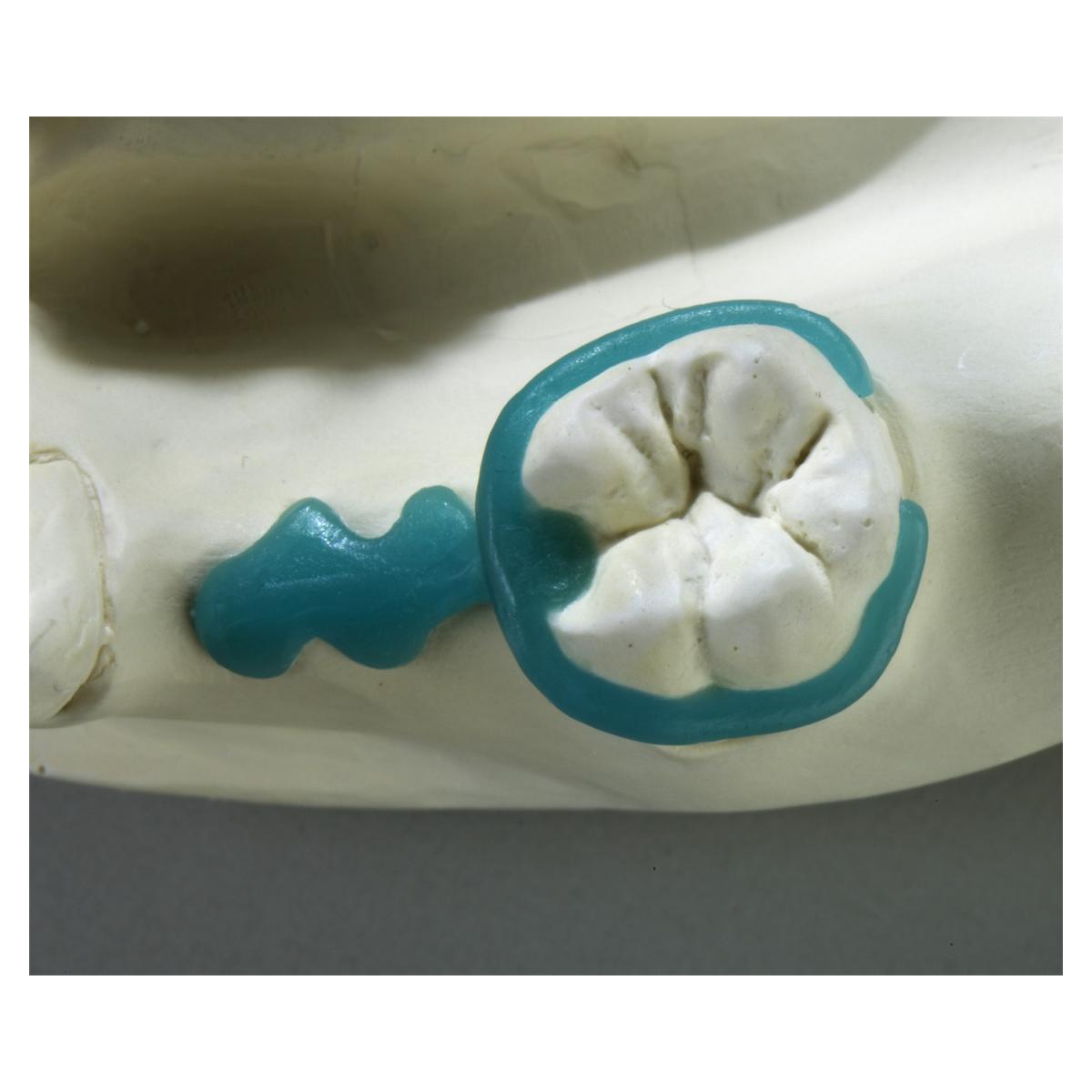 GEO Molaren-Klammern - Selbstklebend, Packung 200 Stück