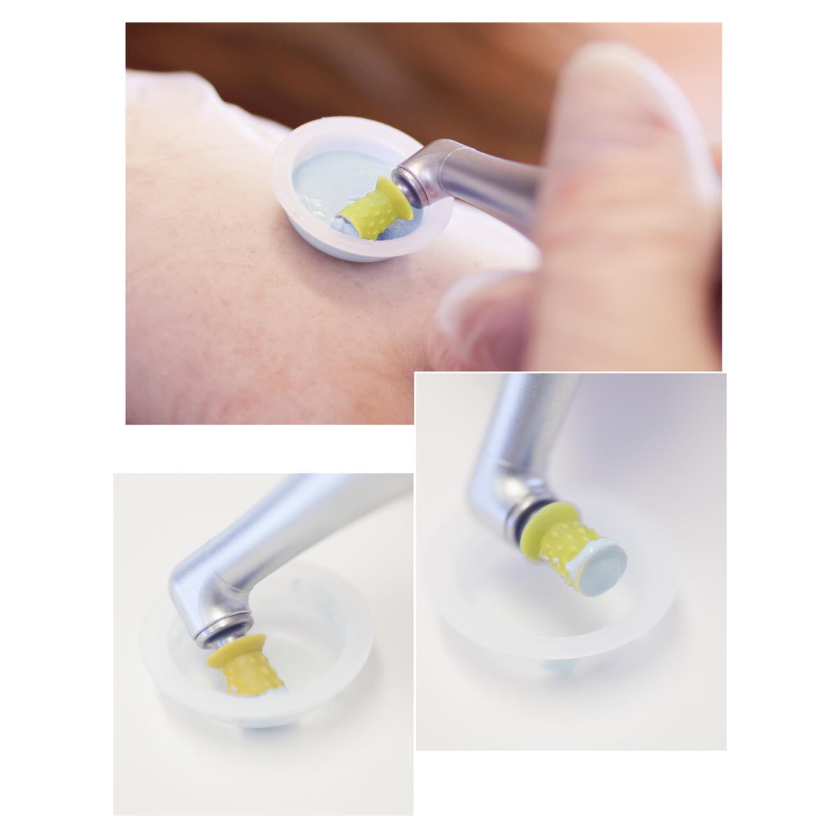 ProphyCare Prophy Cup - Screw-in, Packung 144 Stück