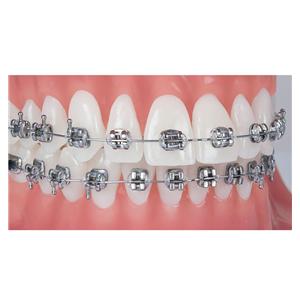 Pinnacle Roth Prescription .022" Slot, Patientenkit - 5er bis 5er, OK + UK, ohne Häkchen, Offset an 4ern und 5ern