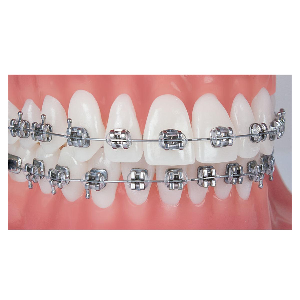 Pinnacle MBT Prescription .022" Slot, mit Torque - Patientenkit - 5er bis 5er, OK + UK, ohne Häkchen, mit Offset an 4ern und 5er