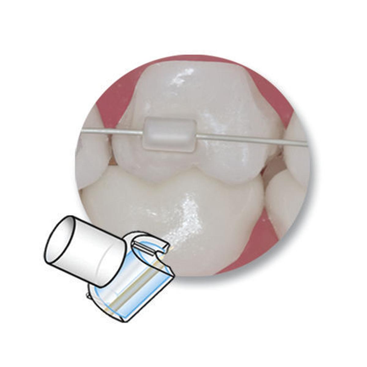 Mini-Mold Röhrchen-Tips - Packung 10 Stück