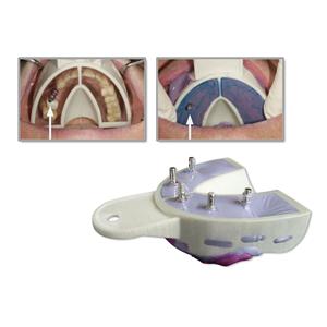 Miratray® Implant - OK S2, Packung 6 Stück